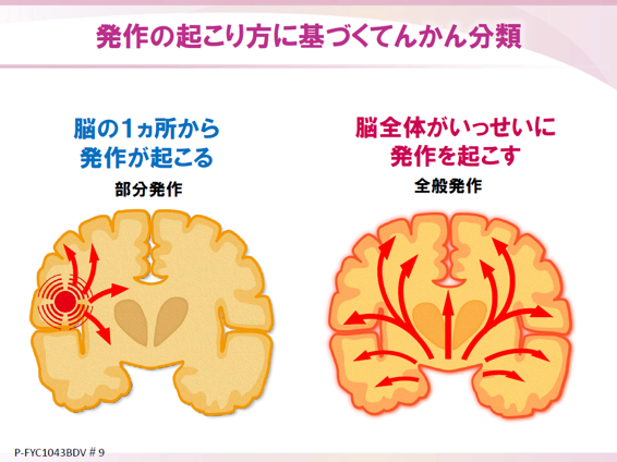 てんかん発作の分類